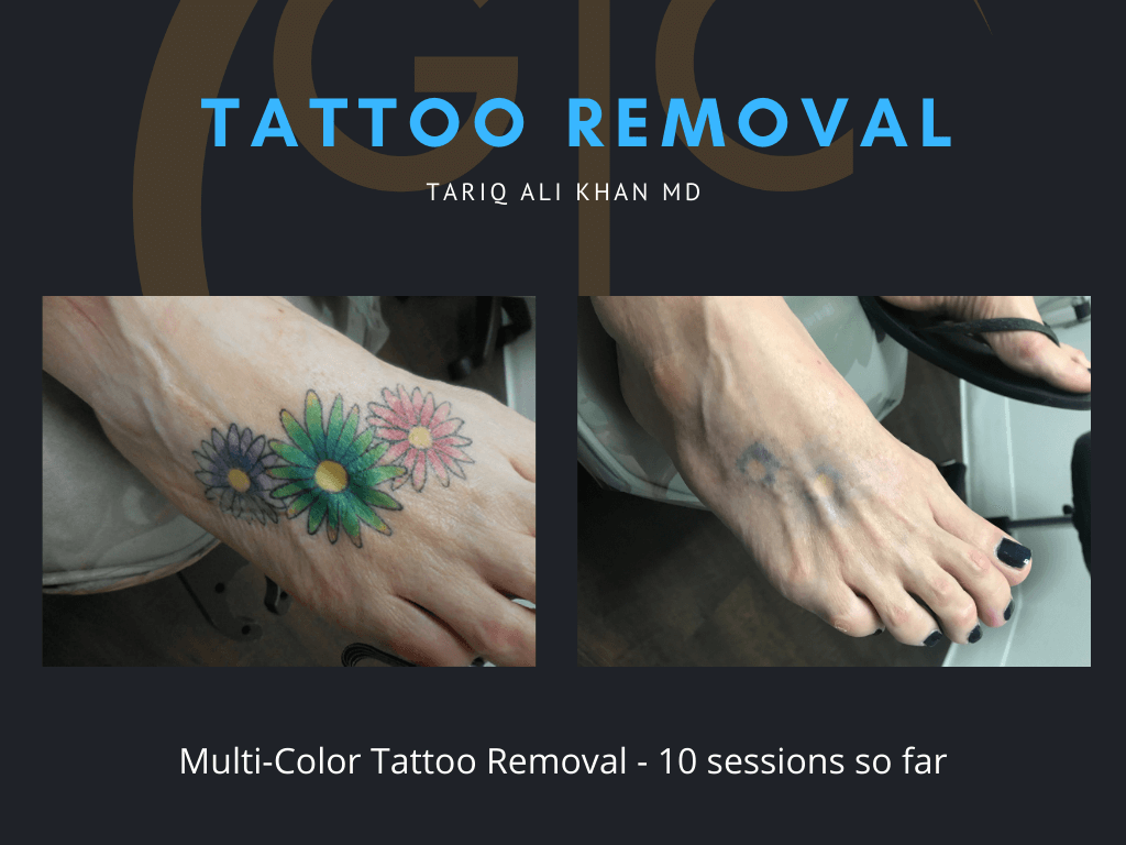 Gentle Care Laser Tustin Before and After picture - Tattoo Removal